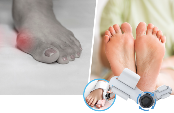 a-bunion-corrector-that-actually-works,-at-last!-aids-in-pain-relief-and-big-toe-alignment