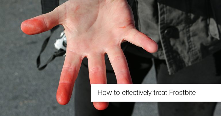 how-to-cure-frostbite-efficaciously