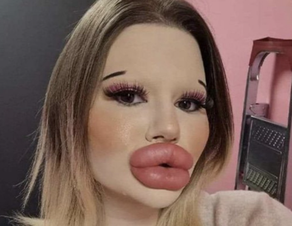 24-year-old-woman-wants-the-biggest-lips-in-the-world