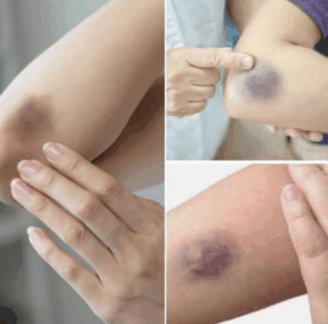 be-careful,-if-you-get-these-bruises-on-your-body,-here’s-what-it-means