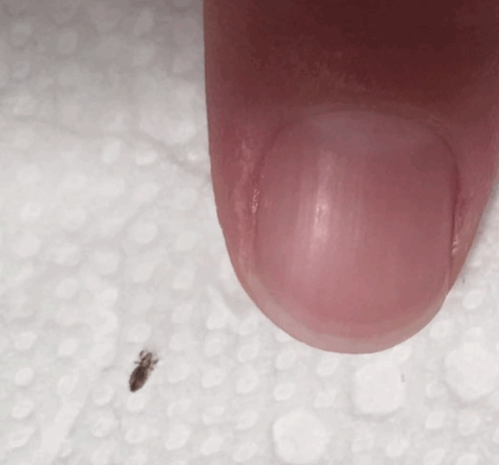 head-lice:-how-to-get-rid-of-them-and-stop-them-coming-back